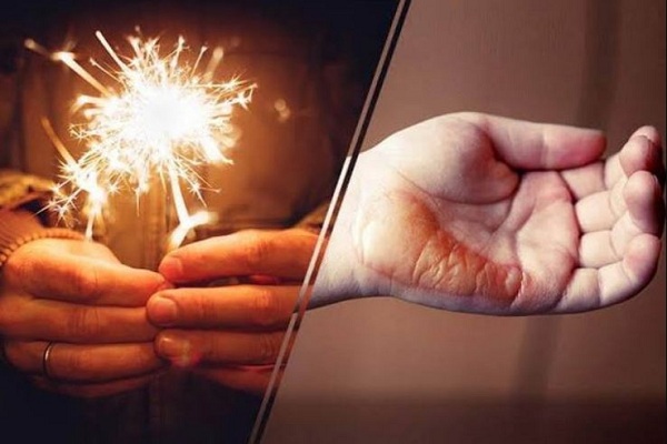 Diwali 2023 : पटाखों से जलने पर अपनाएं ये घरेलू नुस्खे, मिलेगी राहत, जल्द भरेंगे घाव